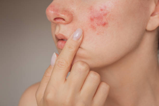 Acne Control Tips