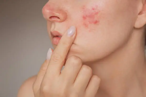 Acne Control Tips